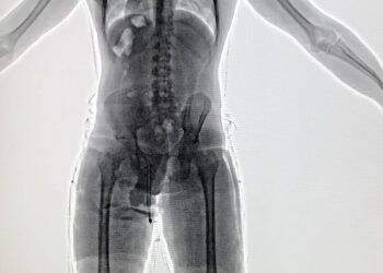 Rapaz é preso no aeroporto com haxixe escondido nas pernas