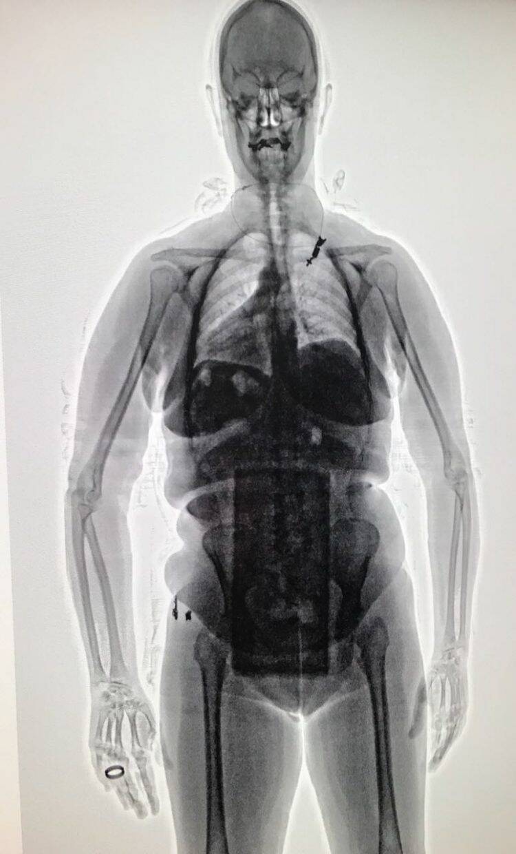 Mulher é presa no Aeroporto de Foz com drogas presas ao corpo