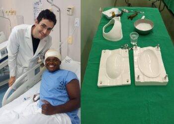 Hospital Costa Cavalcanti utilizou técnica inédita para moldar implante ósseo e reconstituir crânio de paciente