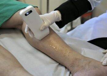 Secretaria de Saúde oferece novo tratamento para varizes