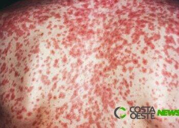 Após 20 anos, Santa Helena registra novo caso positivo de Sarampo